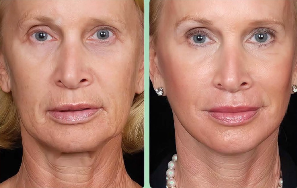 Avant et après un soin d’acupuncture esthétique du visage