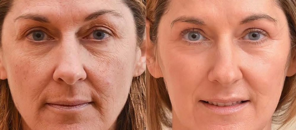 Avant et après : ridules et cernes du contour des yeux